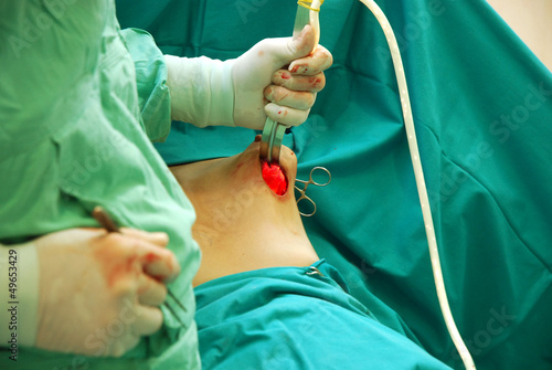 Obraz na płótnie Breast augmentation surgery