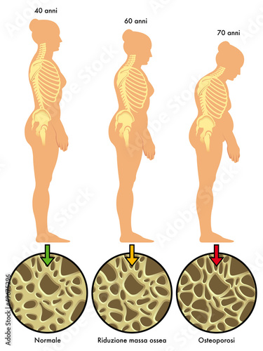 osteoporosi 3