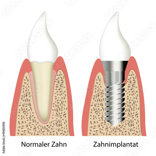 vergleich gesunder zahn - implantat