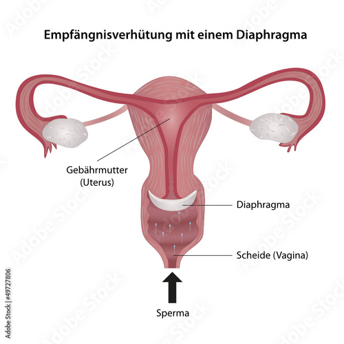 Empfängnisverhütung mit Diaphragma