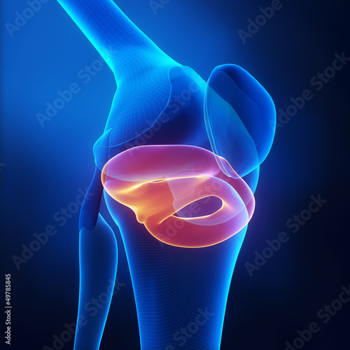 Canvas Print Meniscal Injuries