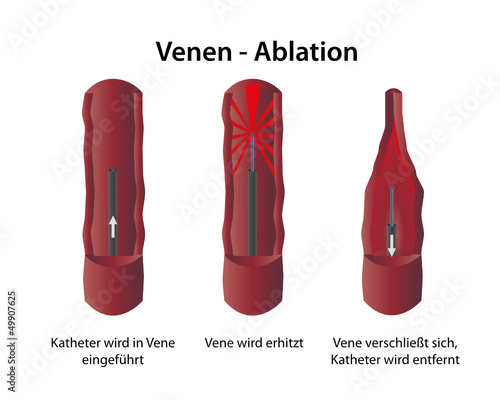 darstellung einer venen ablation