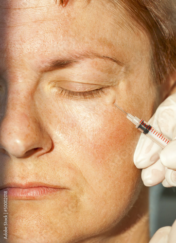 Cosmetic injection near eyelid photo