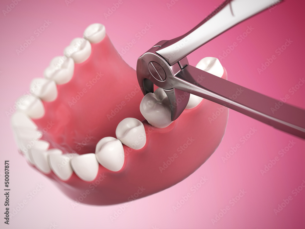 Wall Mural 3d rendered illustration of a tooth extraction