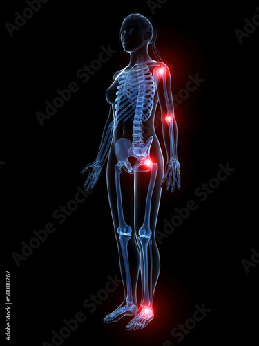 Bilde på lerret 3d rendered illustration of painful joints
