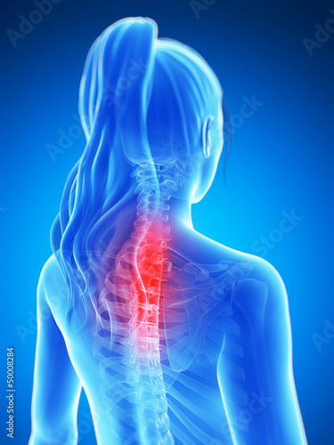 3d rendered illustration of a painful neck