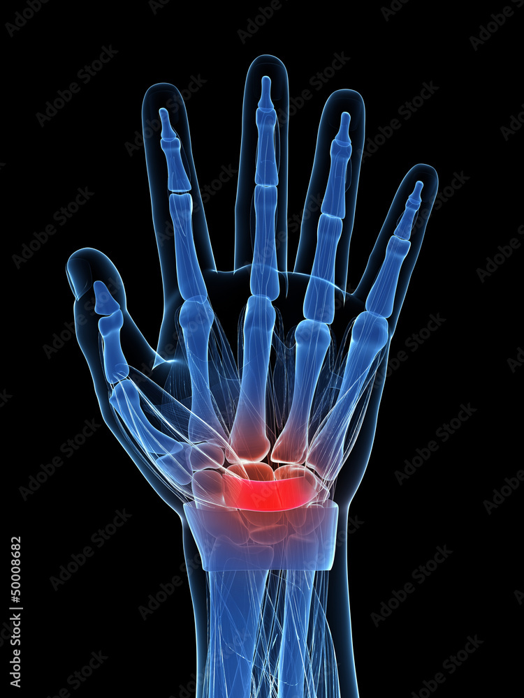 Naklejka premium 3d rendered illustration of the carpal tunnel syndrome