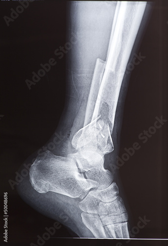 X-rays of leg fracture patients