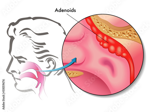 adenoidi