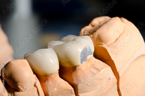 Detail  Keramik-Zahnkronen auf Gipsmodell mit Besch  digung