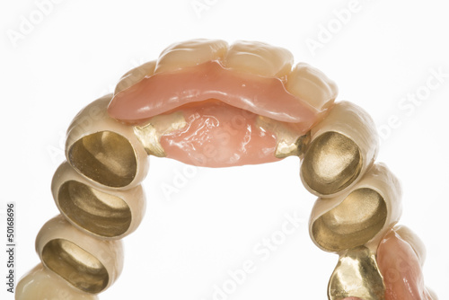 Zahnmodel -  Teleskopkombinationsprothese