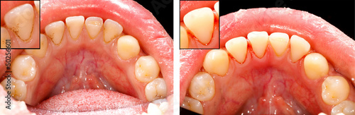 Photos Clean teeth - before and after