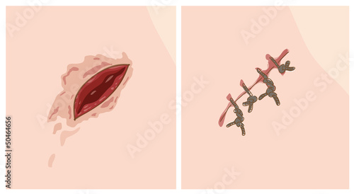 Wound and scar.