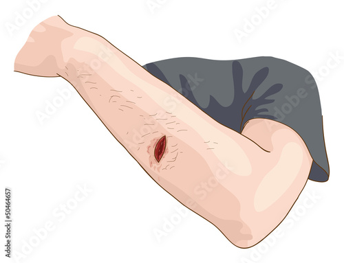 The Wound.
