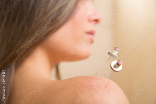 Obraz na plátně moxibustion acupunture needles heat on woman