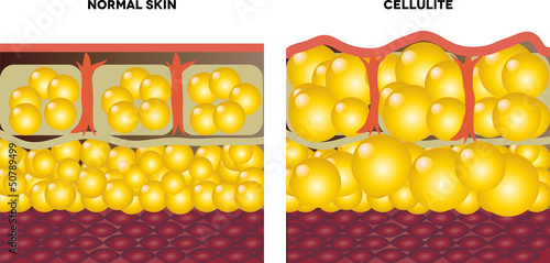 Cellulite and normal skin