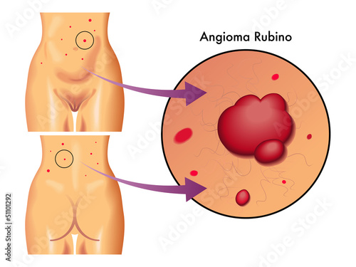 angioma rubino