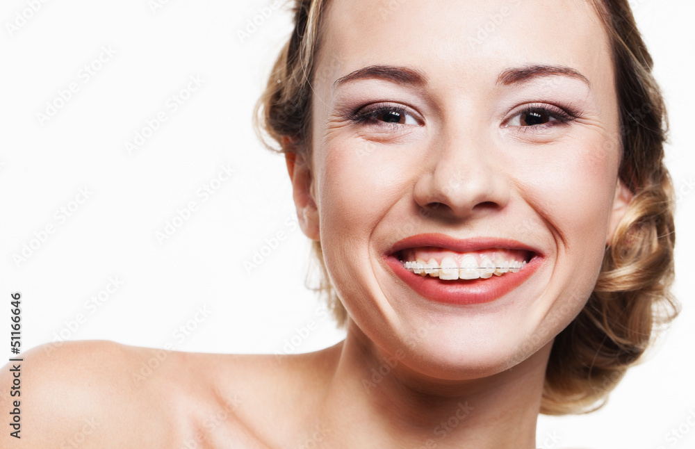 Smile with dental braces Smile with dental braces