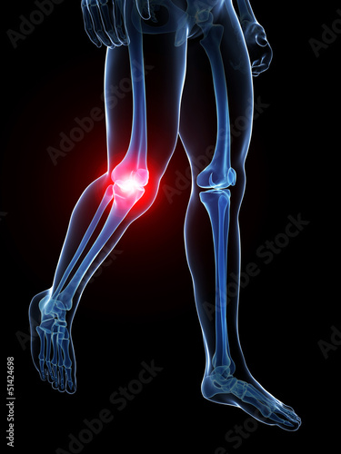 3d rendered medical illustration - painful knee