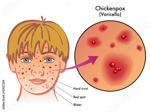 varicella