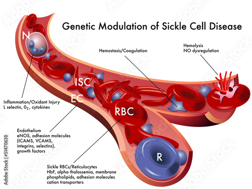 Modulazione genetica anemia falciforme photo