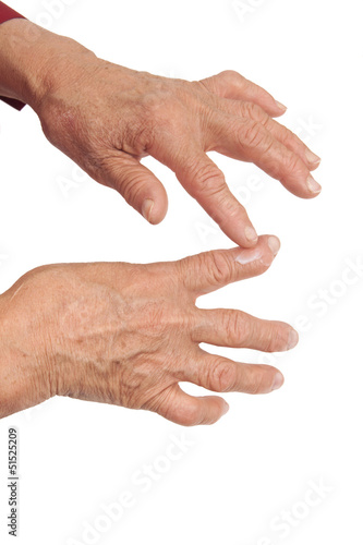 Rheumatoid arthritis of the fingers. Using medical cream