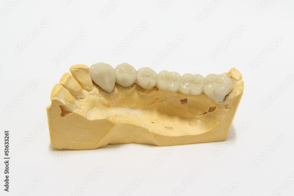 A finished model of posterior dental bridge