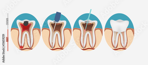 Print op canvas Root canal process