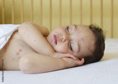 Fotografie Child with chicken pox