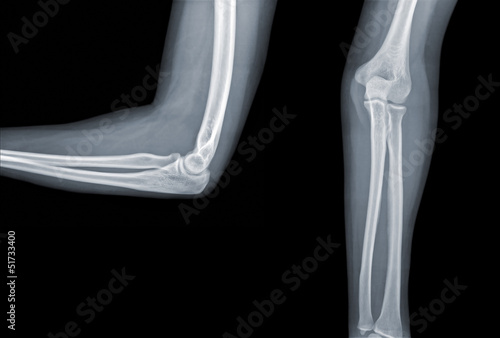 Photography X-ray elbow