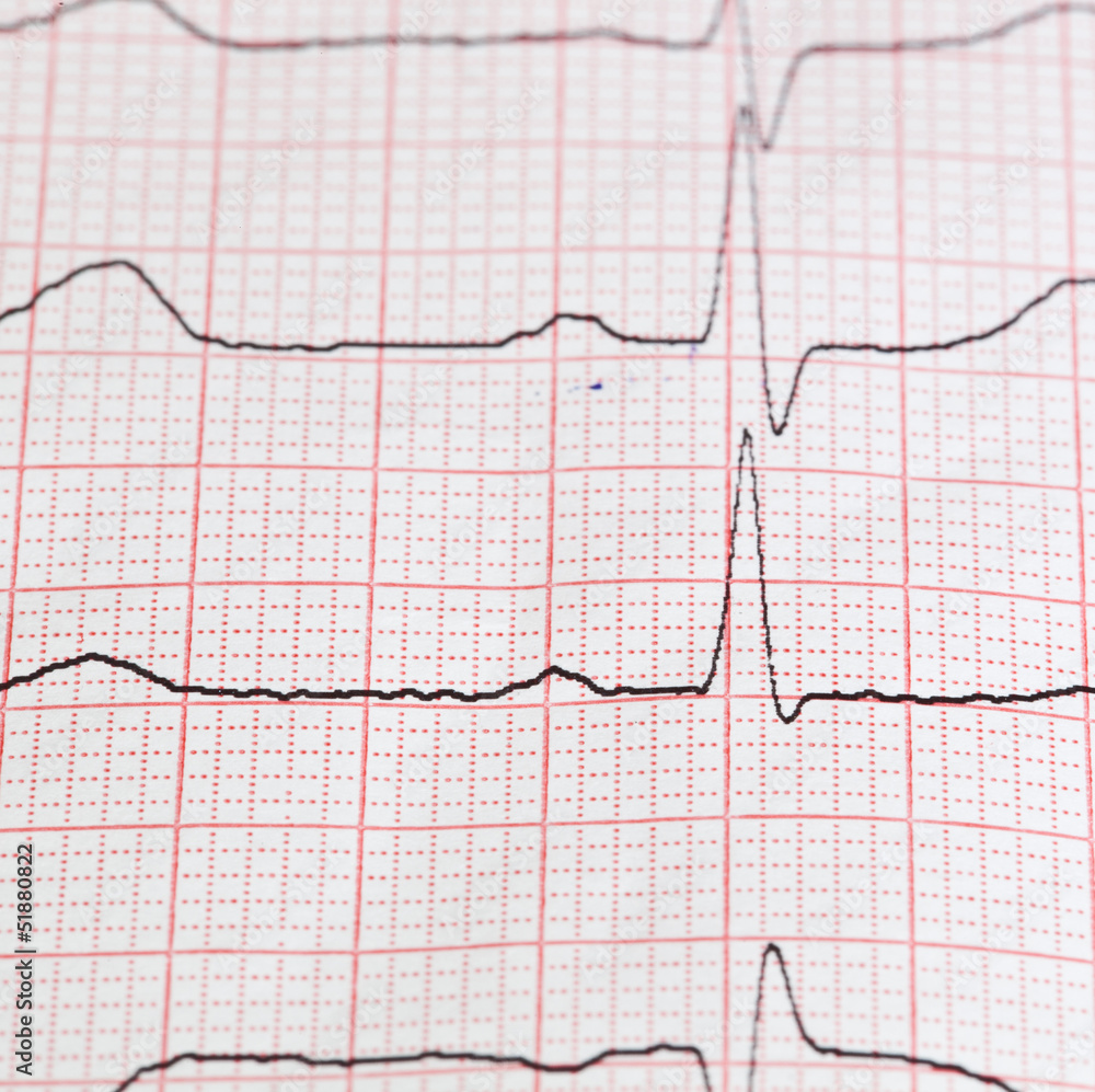 cardiogram