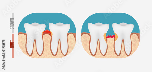 Periodontal tooth disease