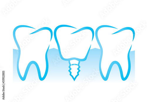 Dental implant