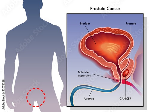 cancro della prostata