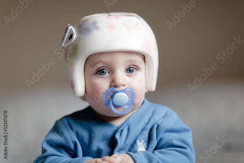 baby with helment for Plagiocephaly