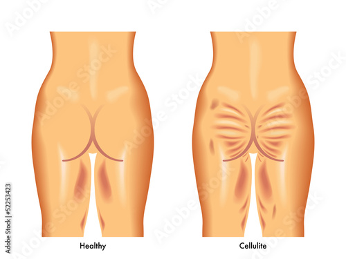 cellulite