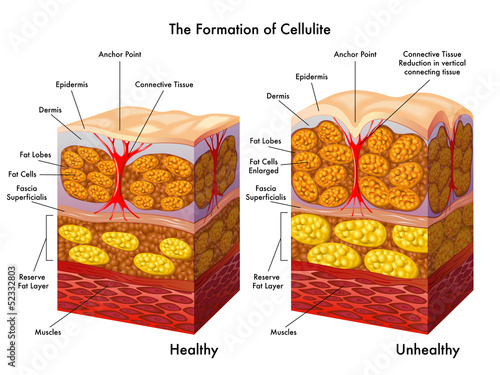 formazione della cellulite photo