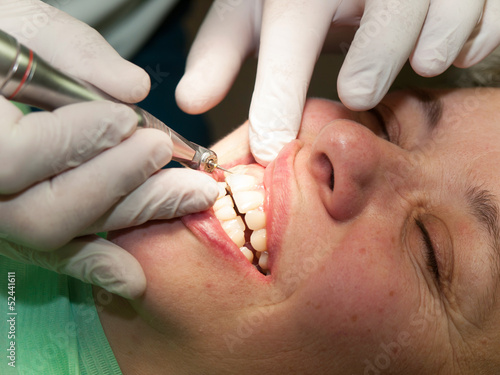 Dentis making dental filling on front tooth