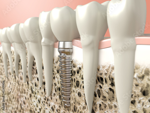 Dental implant #52499016