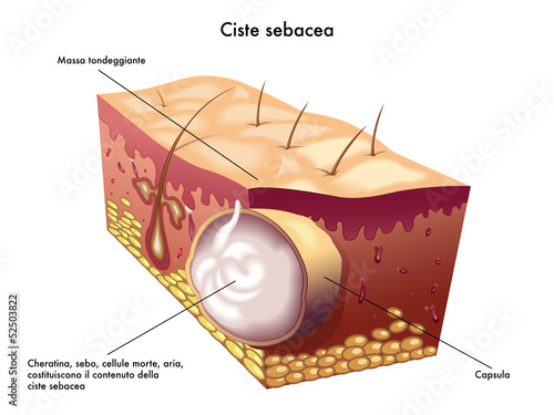 ciste sebacea
