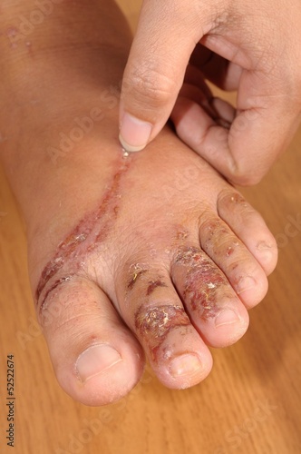 Billede på lærred Wounds on women foot