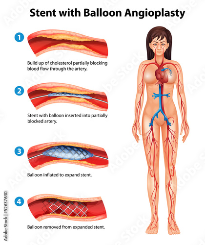 Stent angioplasty procedure
