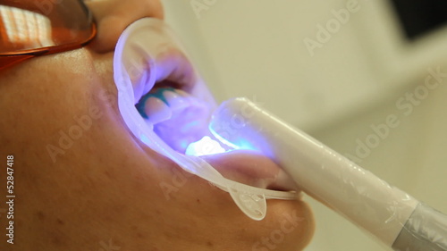 Teeth Whitening. Activation of the gel polymerization light. 