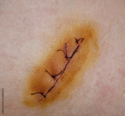 Wound with surgical stitch