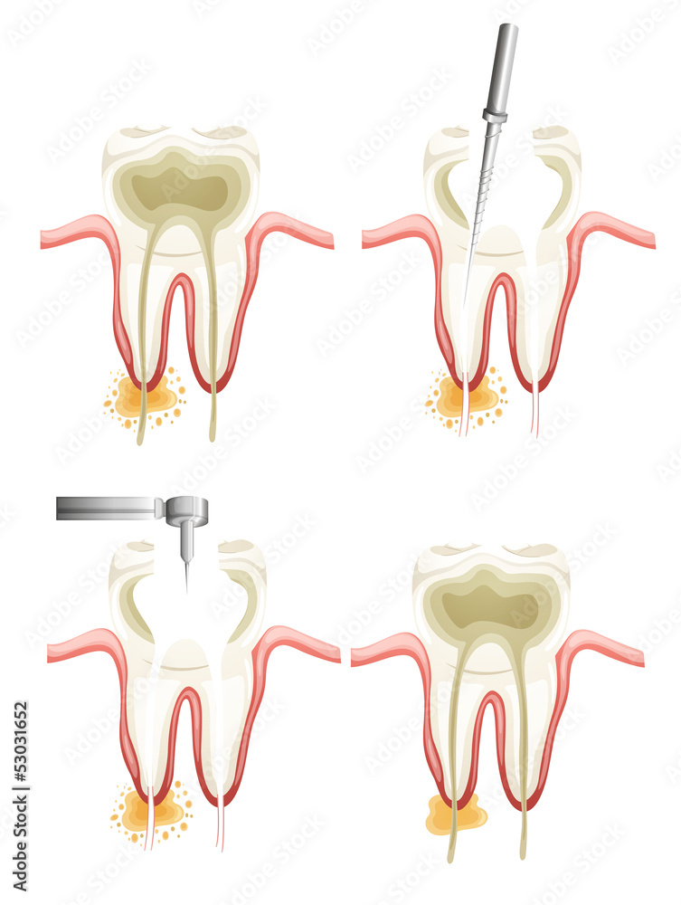 Naklejka premium Root canal procedure