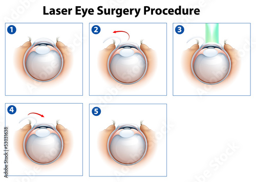Laser Eye Surgery Procedure