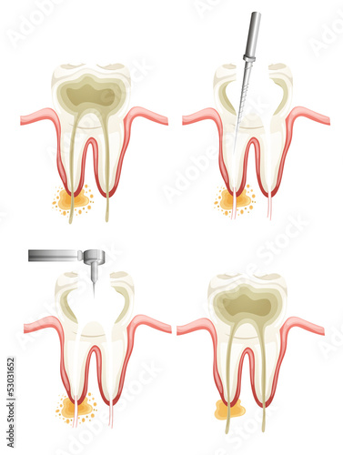 Root canal procedure
