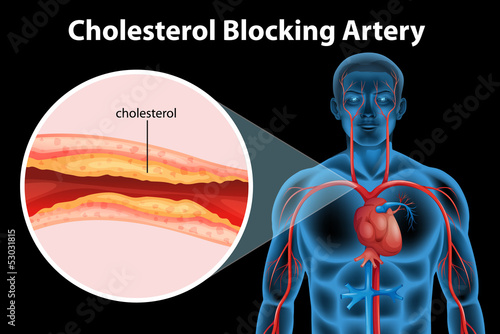 Ateriosclerosis