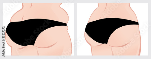 buttocks before-after