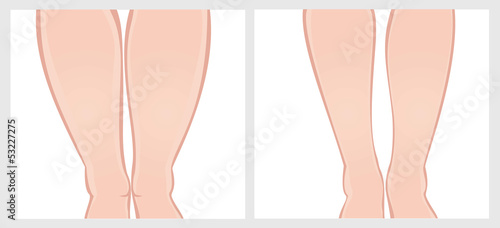 ankles before-after
